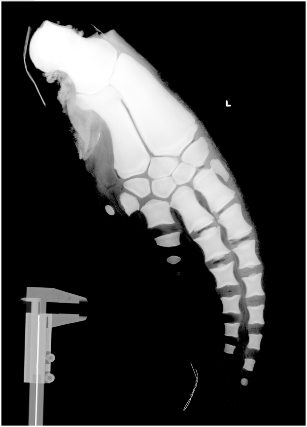 Ein Röntgenbild eines Mannes mit einem Beinbruch in der Mitte, mit einem Metallband auf der linken Seite, vor schwarzem Hintergrund.