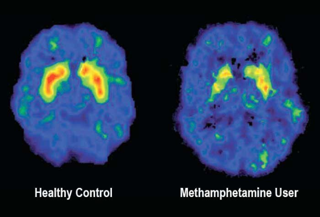 Zwei nebeneinanderliegende MRI-Brain-Scans, die einen gesunden Kontrollpatienten und einen Methamphetamin-Nutzer vergleichen, mit Letzterem beschriftet am unteren Rand.